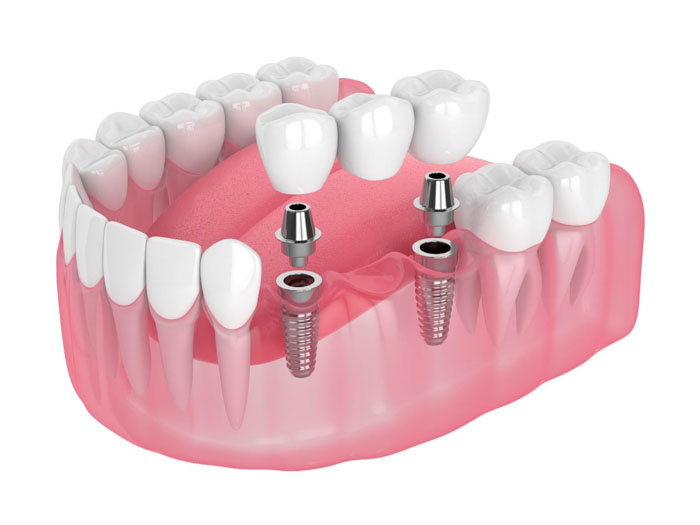 Răng Implant áp dụng cho trường hợp mất nhiều răng liền kề