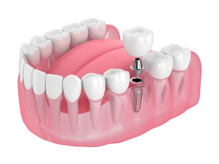 Răng Implant trồng độc lập ngay tại vị trí răng mất