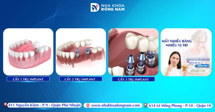 Trồng răng Implant là gì? Giá bao nhiêu và những điều cần biết
