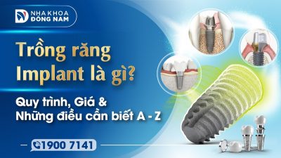 Trồng răng Implant là gì? Quy trình, Giá & Những điều cần biết A - Z