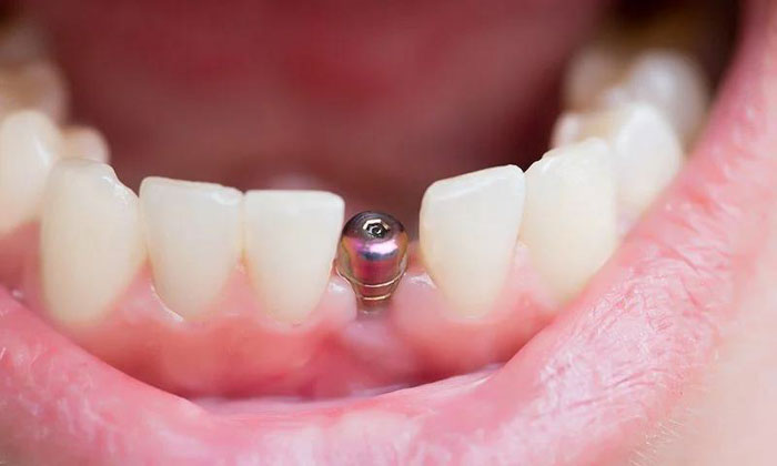 Trụ Implant tồn tại an toàn trong khoang miệng