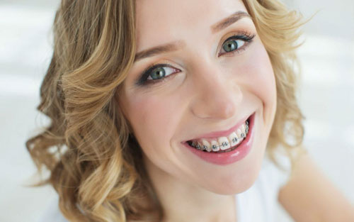 25-30 tuổi vẫn có thể niềng răng được hiệu quả