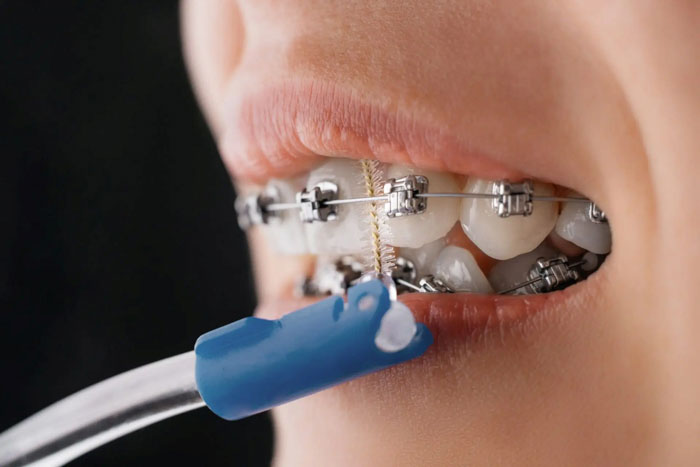 Chăm sóc vệ sinh răng niềng sạch sẽ