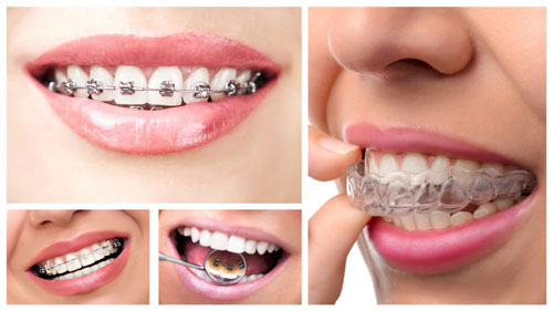Đa dạng các phương pháp niềng răng để bệnh nhân lựa chọn