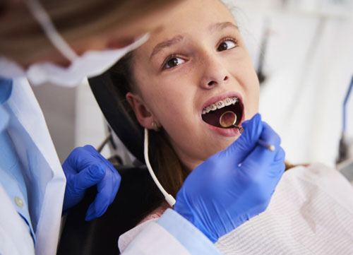 Độ tuổi lý tưởng đế niềng răng cho trẻ là từ 12 – 16 tuổi