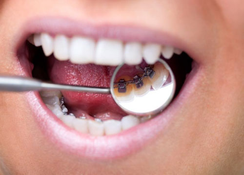 Mắc cài mặt lưỡi với khí cụ được gắn ở mặt trong của răng