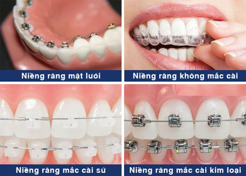 Mỗi phương pháp niềng răng sẽ có các đặc điểm riêng biệt