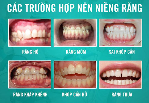 Niềng răng áp dụng được cho nhiều trường hợp