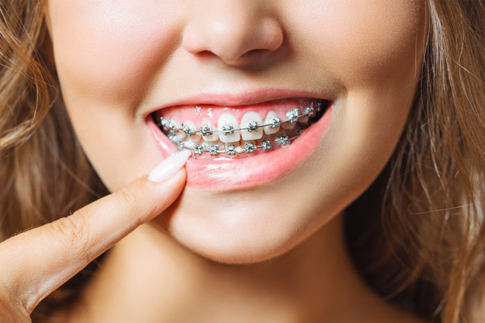 Niềng răng là phương pháp giúp răng sắp xếp đều đặn đúng vị trí trên cung hàm