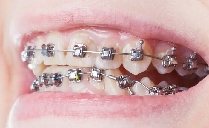 Niềng răng mắc cài kim loại tự buộc giúp rút ngắn thời gian đeo niềng