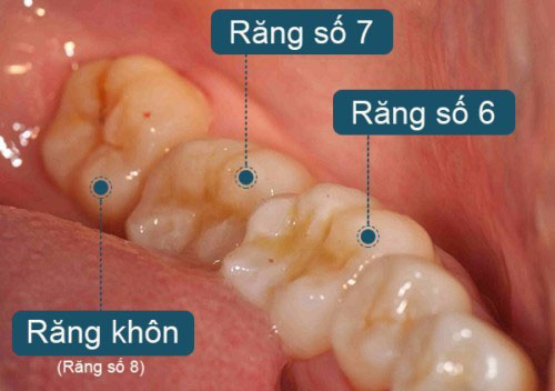 Răng khôn mọc ở vị trí cuối của cung hàm trong độ tuổi từ 18-25