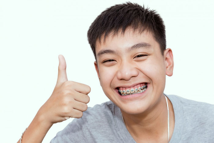 Thời gian niềng răng ở mỗi người là khác nhau