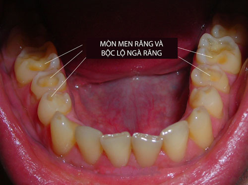 Răng sẽ trở nên nhạy cảm hơn khi bị mòn men