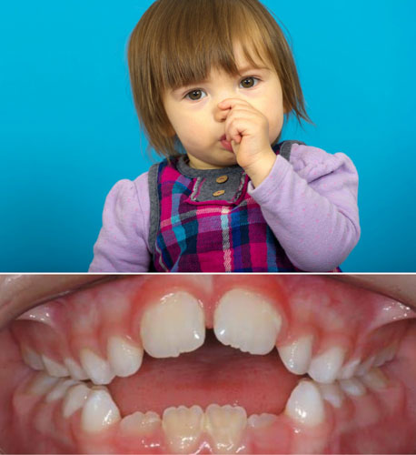 Tật mút tay rất có hại cho quá trình mọc răng ở trẻ