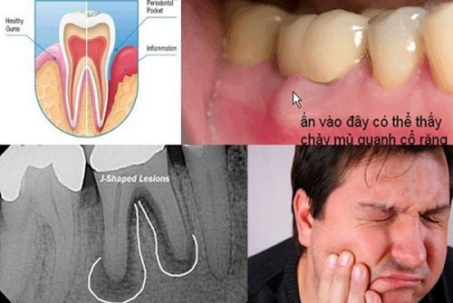 Các triệu chứng của áp xe răng gây nhiều khó chịu cho bệnh nhân
