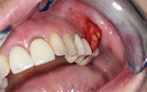 Cần sớm điều trị áp xe quanh chóp răng để tránh biến chứng