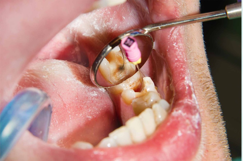 Có thể bọc răng sứ sớm với trường hợp sâu răng nặng nhưng cần hoàn tất quá trình thay răng sữa
