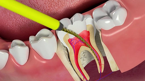 Điều trị tủy sai kỹ thuật có nguy cơ cao dẫn đến áp xe răng quanh chóp răng