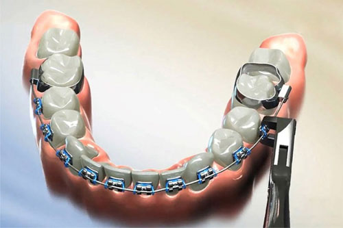 Khi hàm răng đã đều đặn bác sĩ sẽ tháo khí cụ kết thúc quá trình chỉnh nha