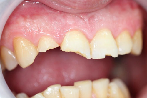 Răng bị gãy mẻ dễ khiến bệnh nhân bị đau nhức, ê buốt