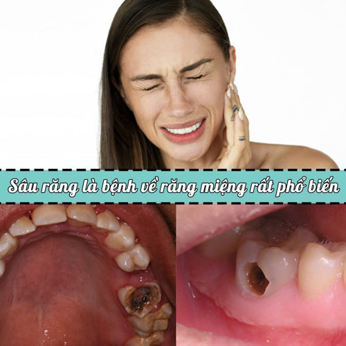 Sâu răng là nguyên nhân hàng đầu gây đau nhức ở răng