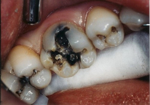 Sâu răng nghiêm trọng dễ dẫn đến hình thành áp xe ở răng