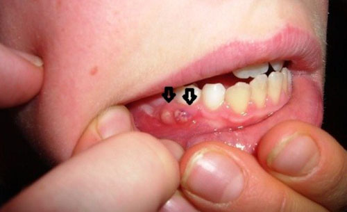 Áp xe răng là bệnh lý gây nhiều khó chịu cho trẻ