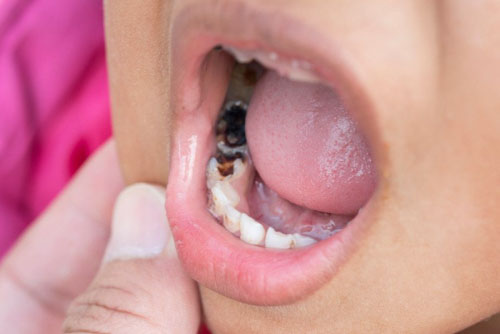 Bé bị sâu răng hàm sữa do nhiều nguyên nhân