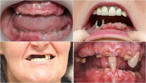 Cấy ghép Implant Multi phù hợp cho bệnh nhân bị mất răng toàn hàm