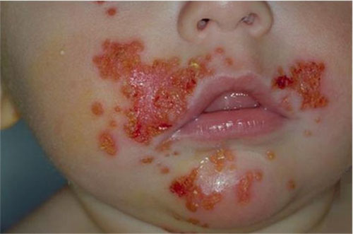 Hình ảnh bệnh chốc mép thường thấy ở trẻ