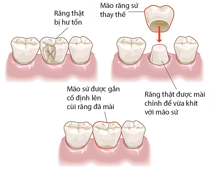 Kỹ thuật bọc răng sứ thẩm mỹ