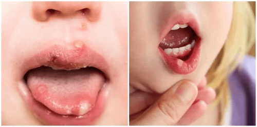 Nhiệt miệng là tình trạng khá phổ biến ở trẻ em