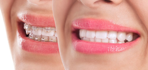 Niềng răng giúp hàm răng đều đẹp, cân đối hơn