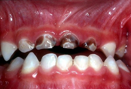 Thói quen bú bình cũng góp phần khiến răng của trẻ dễ sâu hỏng