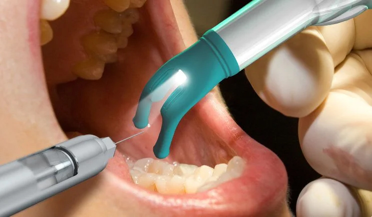 Gây tê cục bộ giúp bệnh nhân không thấy đau suốt quá trình điều trị