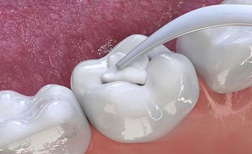 Trám răng composite để tái tạo lại hình thể răng