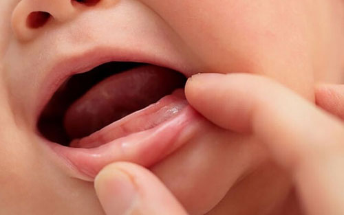Trẻ chậm mọc răng có thể do di truyền, bẩm sinh