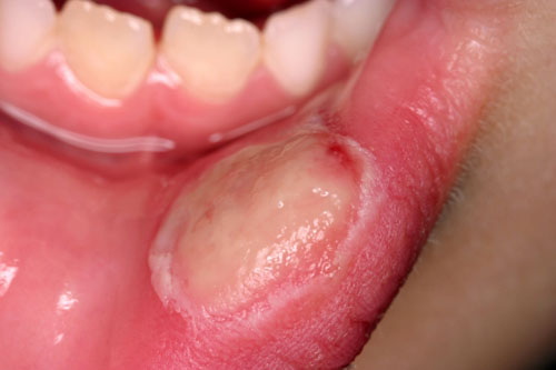 Bệnh cam miệng có khả năng làm hoại tử nướu và môi