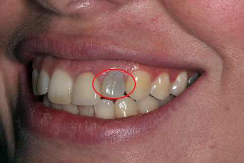 Chiếc răng hoại tử tủy thường có màu xám, thậm chí là đen