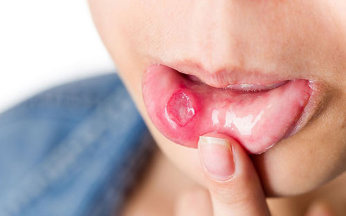 Dấu hiệu ban đầu của bệnh cam miệng tương tự như chứng nhiệt miệng