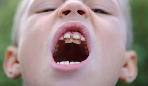Hàm răng của trẻ dễ mọc sai lệch nếu răng sữa mọc chậm
