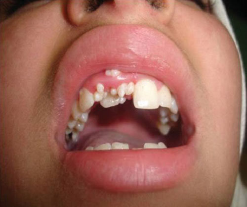 Nguyên nhân bệnh mọc thừa răng vẫn chưa được xác định chính xác