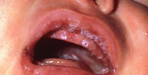 Nhiễm khuẩn ở khoang miệng khiến răng sữa khó mọc lên thuận lợi