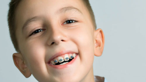 Niềng răng là một trong những giải pháp giúp cải thiện tình trạng cười hở lợi