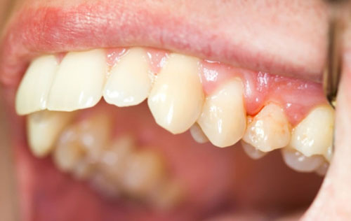 Nướu răng sưng đỏ và dễ chảy máu là dấu hiệu ban đầu của viêm nha chu