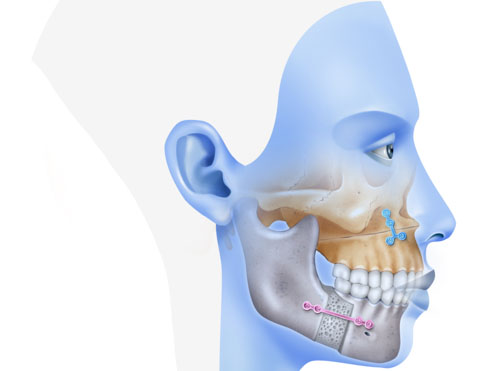 Phẫu thuật hàm với trường hợp cười hở lợi do xương hàm phát triển quá mức
