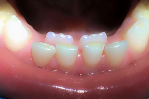 Răng thừa với số lượng răng mọc nhiều hơn so với tiêu chuẩn bình thường