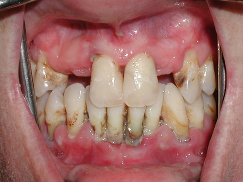 Sưng nướu răng cửa có thể dẫn đến nguy cơ mất răng khá cao
