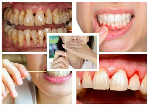 Thói quen dùng tăm xỉa răng rất có hại cho răng lợi