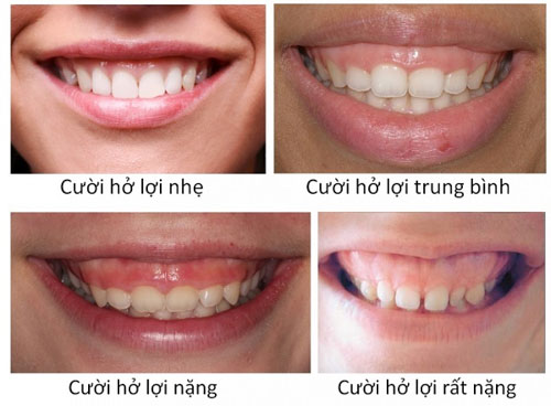 Tình trạng cười hở lợi có nhiều mức độ nặng nhẹ khác nhau